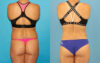 Liposuction case #6009 slider thumbnail