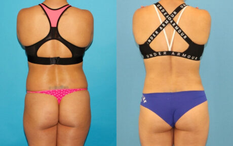 Liposuction case #6009
