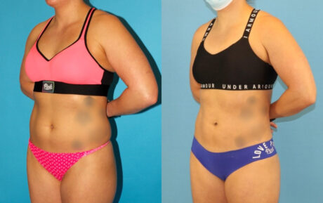 Liposuction case #6009