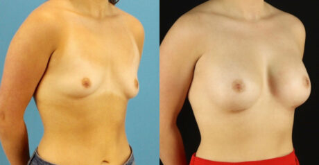 Breast Augmentation case #6327