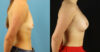 Breast Augmentation case #6327 slider thumbnail
