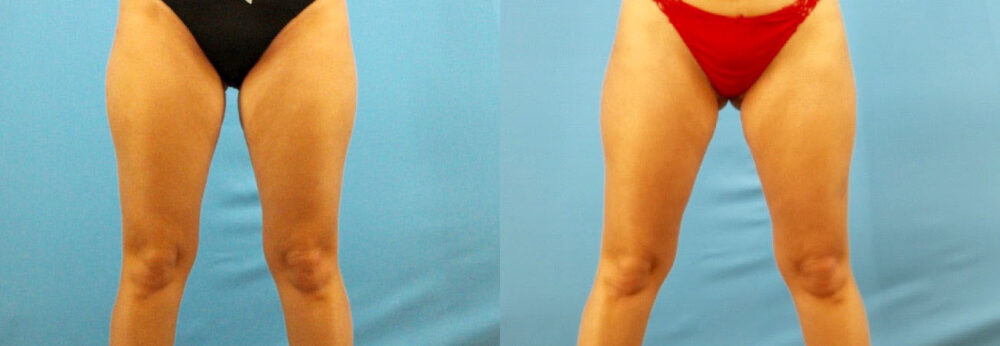 Brazilian Butt Lift case #4963