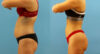 Brazilian Butt Lift case #4963 slider thumbnail