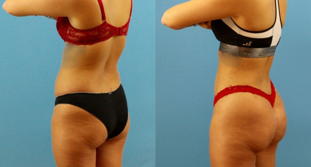 Brazilian Butt Lift case #4963
