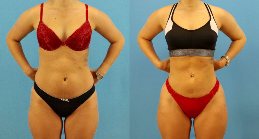 Brazilian Butt Lift case #4963