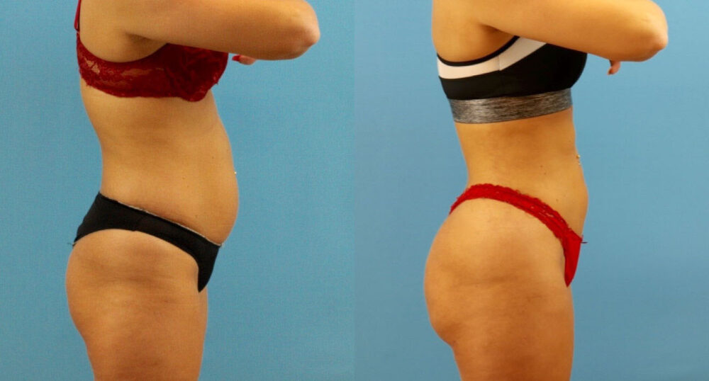 Brazilian Butt Lift case #4963