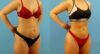 Brazilian Butt Lift case #4963 slider thumbnail