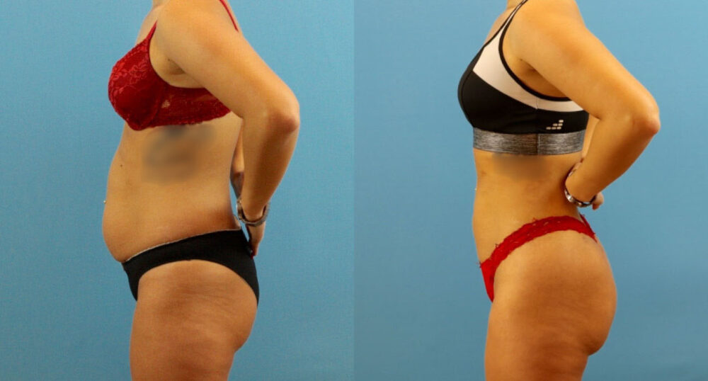 Brazilian Butt Lift case #4963