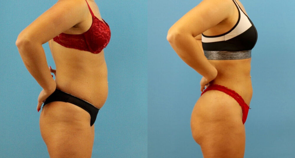 Brazilian Butt Lift case #4963