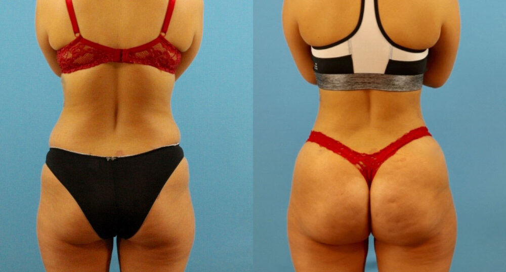 Brazilian Butt Lift case #4963