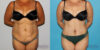 Tummy Tuck case #7165 slider thumbnail