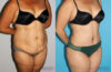 Tummy Tuck case #7165 slider thumbnail