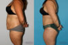 Tummy Tuck case #7165 slider thumbnail