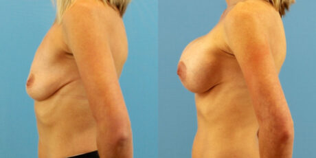 Breast Augmentation case #6333