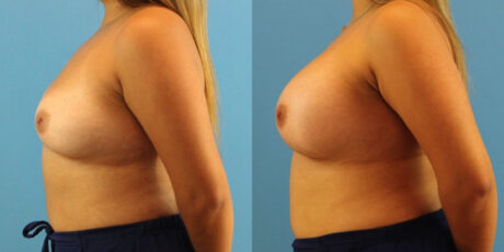 Breast Augmentation case #6340