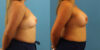 Breast Augmentation case #6340 slider thumbnail