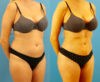 Brazilian Butt Lift case #4964 slider thumbnail