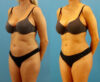 Brazilian Butt Lift case #4964 slider thumbnail