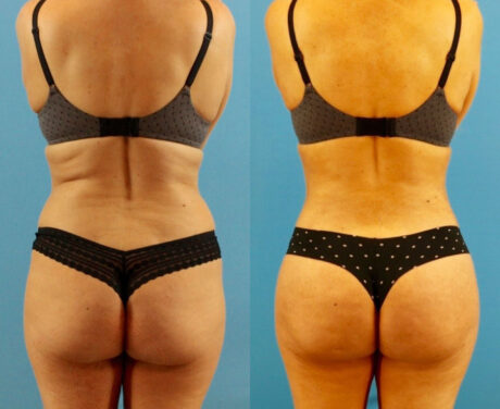 Brazilian Butt Lift case #4964
