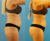 Brazilian Butt Lift case #4964 slider thumbnail