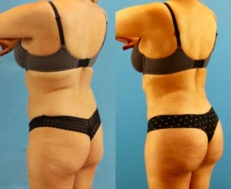 Brazilian Butt Lift case #4964