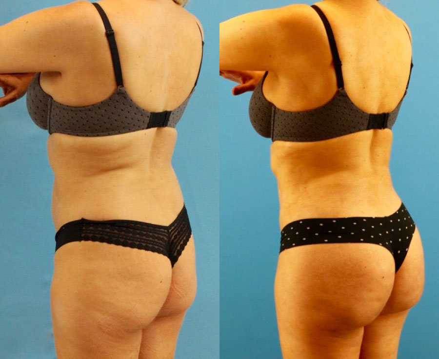 Brazilian Butt Lift case #4964