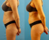 Brazilian Butt Lift case #4964 slider thumbnail