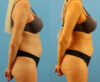 Brazilian Butt Lift case #4964 slider thumbnail