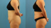 Tummy Tuck case #7346 slider thumbnail