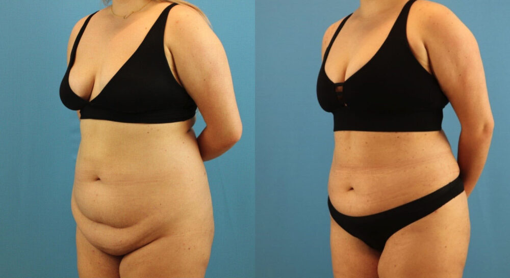 Tummy Tuck case #7346