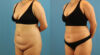 Tummy Tuck case #7346 slider thumbnail