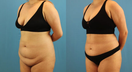 Tummy Tuck case #7346