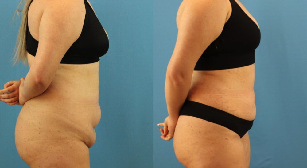 Tummy Tuck case #7346