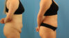 Tummy Tuck case #7346 slider thumbnail