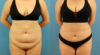 Tummy Tuck case #7346 slider thumbnail
