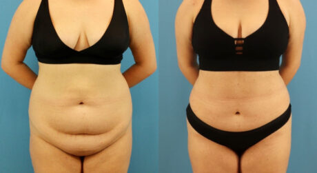 Tummy Tuck case #7346