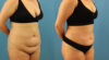 Tummy Tuck case #7346 slider thumbnail