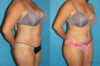 Tummy Tuck case #7087 slider thumbnail