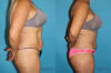 Tummy Tuck case #7087 slider thumbnail
