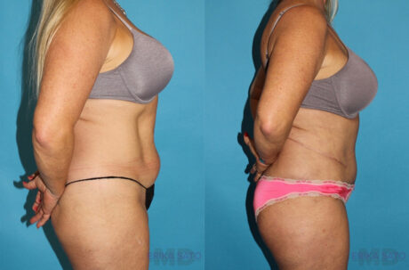 Tummy Tuck case #7087