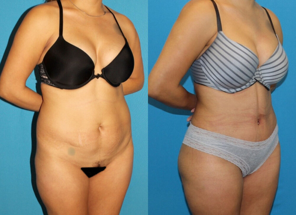 Brazilian Butt Lift case #4965