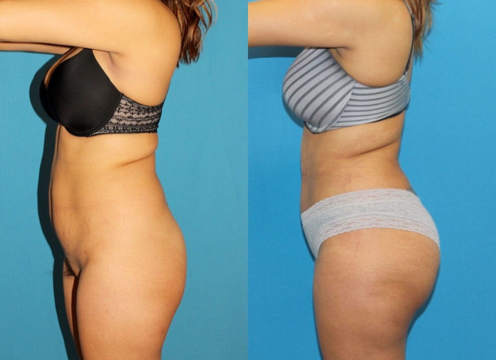 Brazilian Butt Lift case #4965