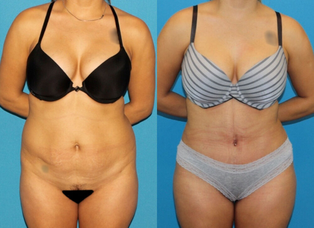 Brazilian Butt Lift case #4965