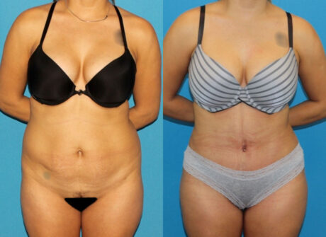 Brazilian Butt Lift case #4965
