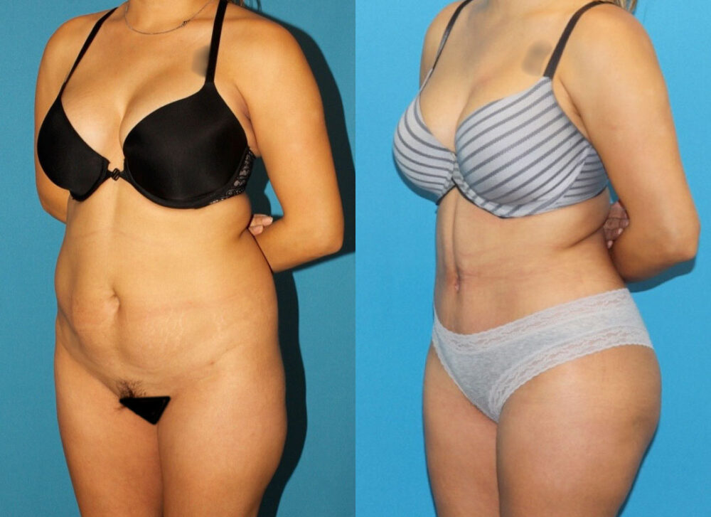 Brazilian Butt Lift case #4965