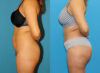Brazilian Butt Lift case #4965 slider thumbnail