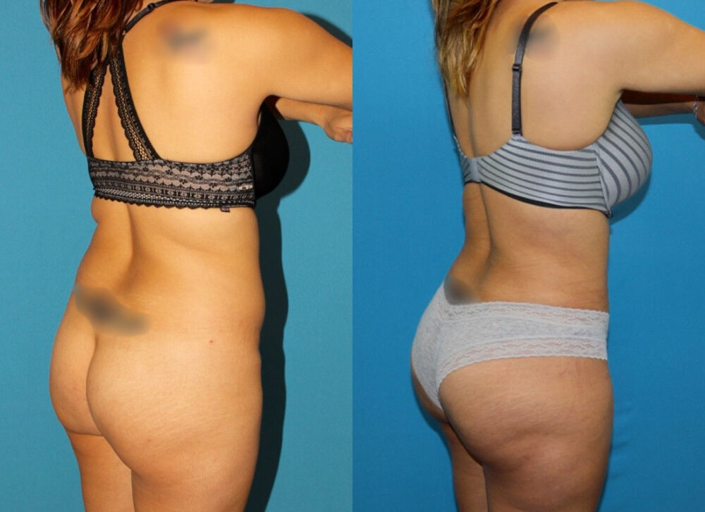 Brazilian Butt Lift case #4965