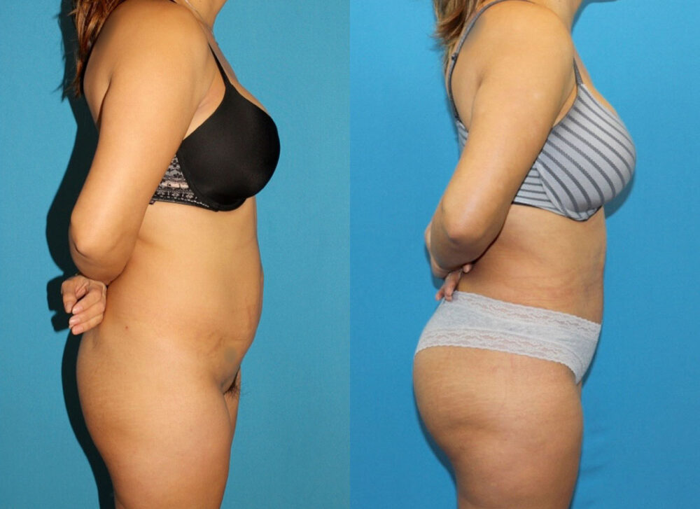 Brazilian Butt Lift case #4965
