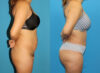 Brazilian Butt Lift case #4965 slider thumbnail