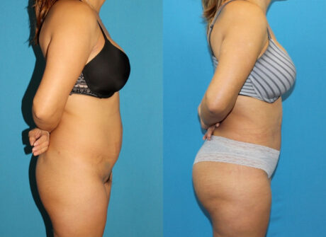 Brazilian Butt Lift case #4965